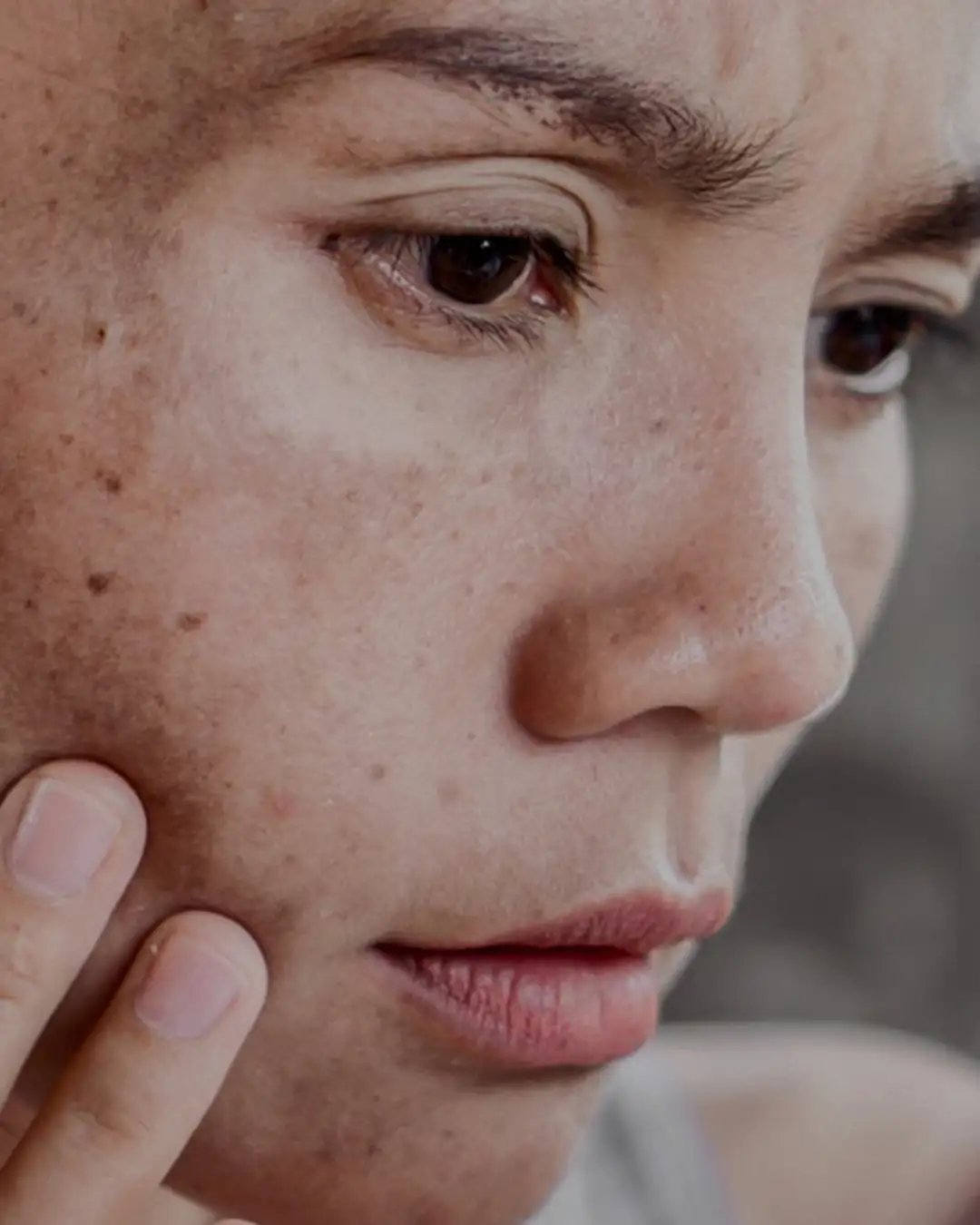 Skin Concern Pigmentation 1