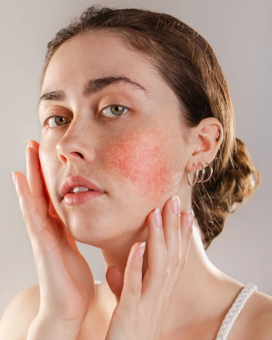 Skin Concern Rosacea 2