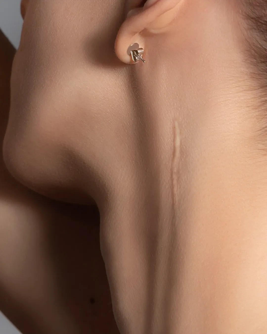 Skin Concern Scarring 1