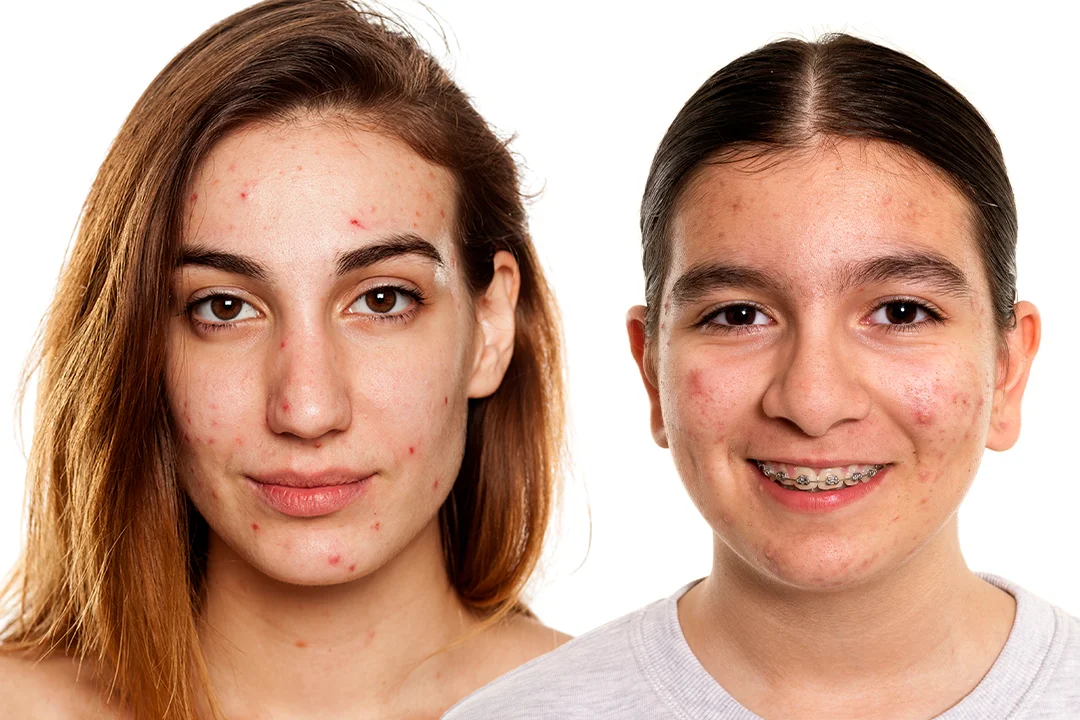 Image Clear Skin Journey Adult Teen Thumbnail