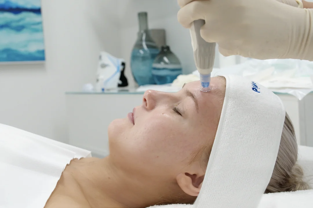 Microneedling Insights