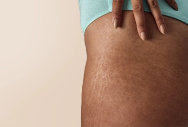 Skin-Concerns-Stretch-Marks