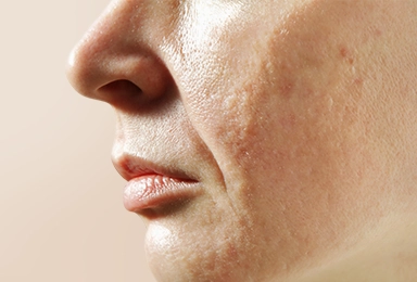 Skin-Concerns-Enlarged-Pores