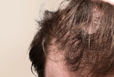 Skin-Concerns-Hair-Loss