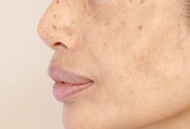 Skin-Concerns-Pigmentation Homepage