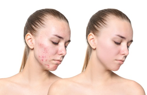 Dermapen-For-Scars-Achieve-Flawless-Skin-With-Micro-Needling-Treatment
