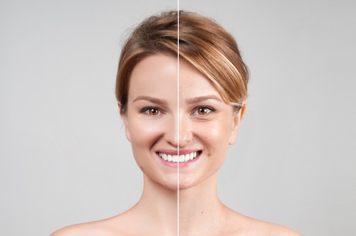 A-Brief-Introduction-To-Dermapen-Needling-For-Skin-Rejuvenation
