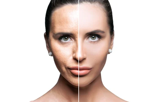 Microneedling-Before-And-After-Results-The-Things-To-Expect-After-Your-First-Dermapen-Treatment