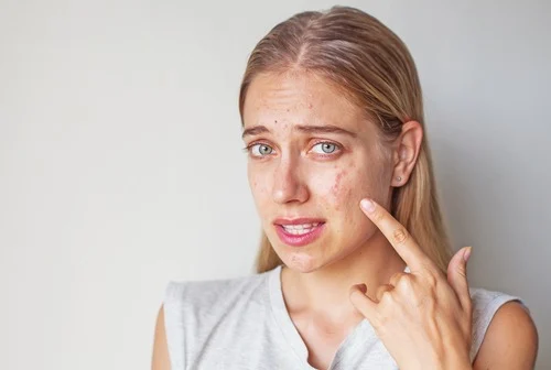 5-Alarming-Risks-The-Wrong-Skin-Needling-Cosmetics-Expose-You-To