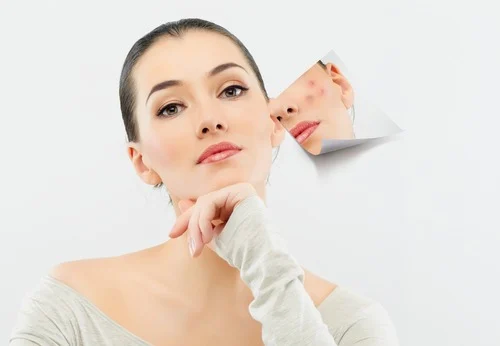 The-Role-Of-Microneedling-In-Acne-Vulgaris-Treatment-And-Other-Skin-Conditions