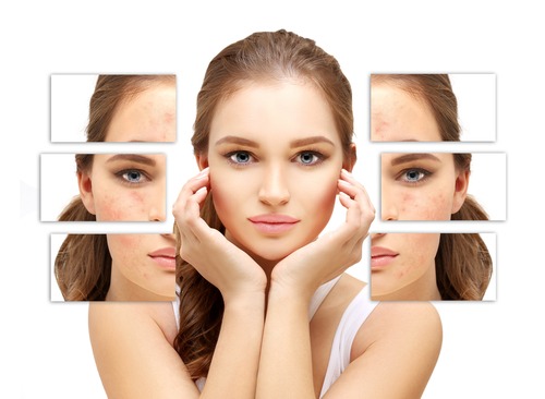 Skin-Needling-To-Heal-Acne-Scars-What-You-Need-To-Know-About-The-Procedure