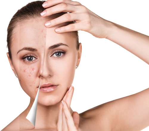 Skin-Needling-Benefits-Every-Woman-Should-Know