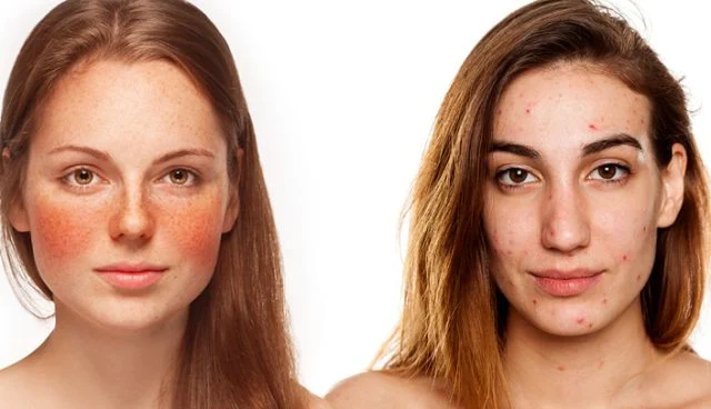 Rosacea-Vs-Acne-640x368