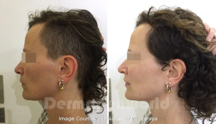 Women Alopecia