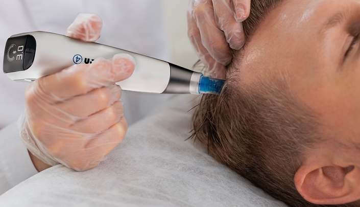 Microneedling With Exosomes For Hair Growth 1