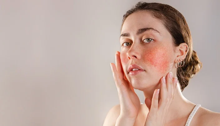 Rosacea-Skin-Condition