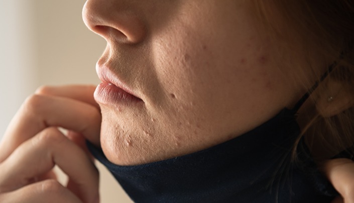 Maskne Surgical Mask Acne