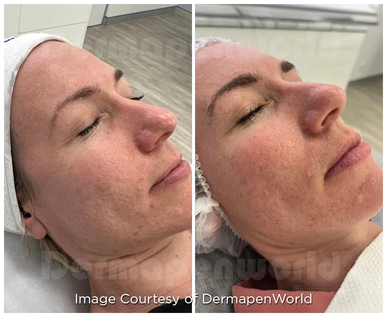 Microneedling Before And After