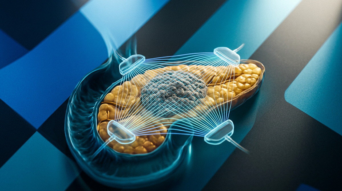 Novocure Array Novocure (NVCR) reports positive Phase 2 PANOVA-4 results | Grafa