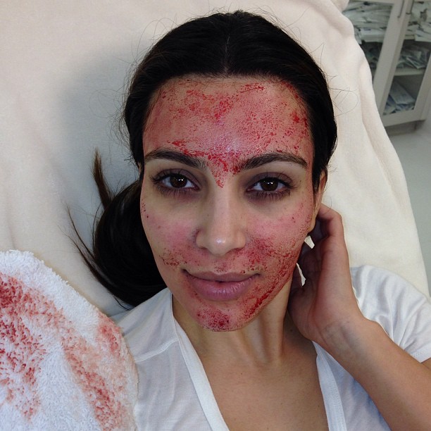 Kim Kardashian during a vampire facial