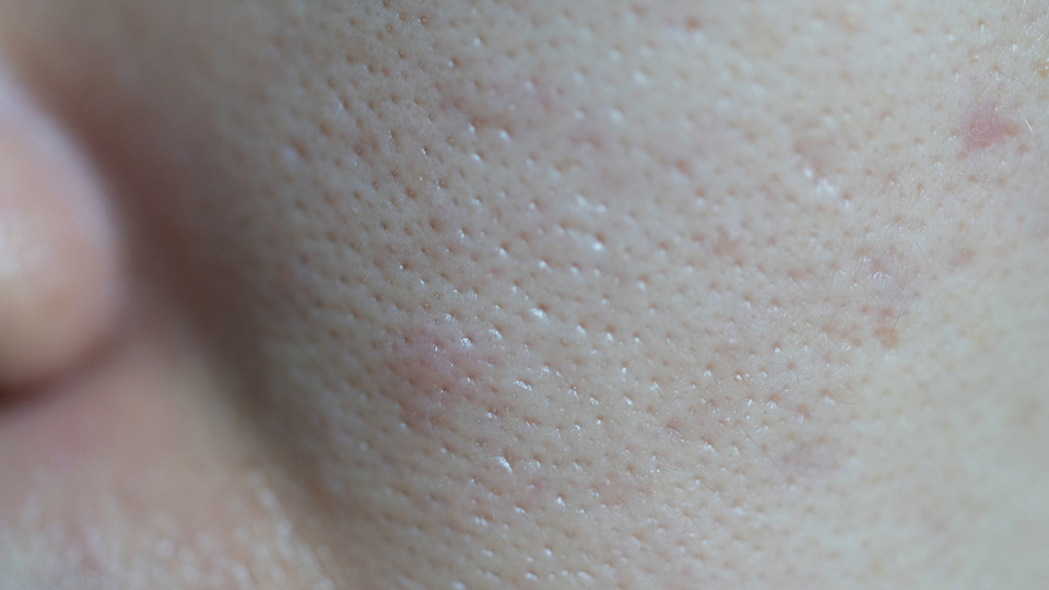 Large pores