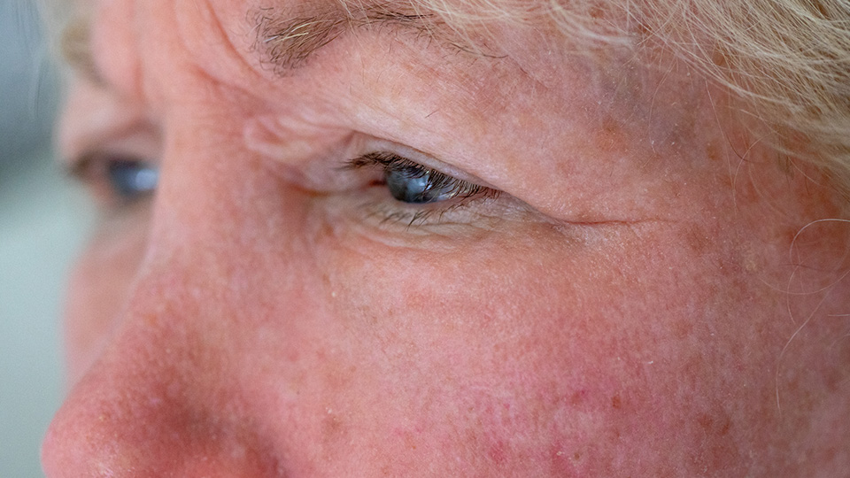 Redness (rosacea)