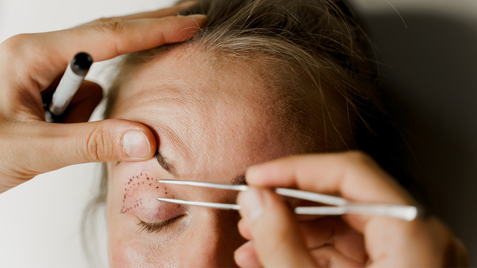 Surgical eyelid lift