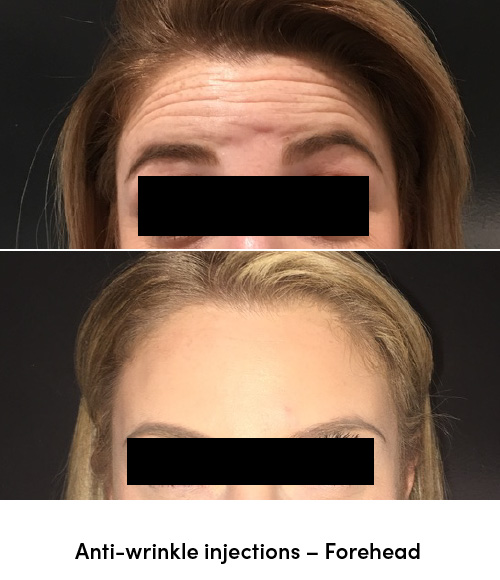 Anti wrinkle injections forehead