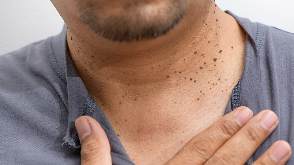 What are skin tags and what causes them?