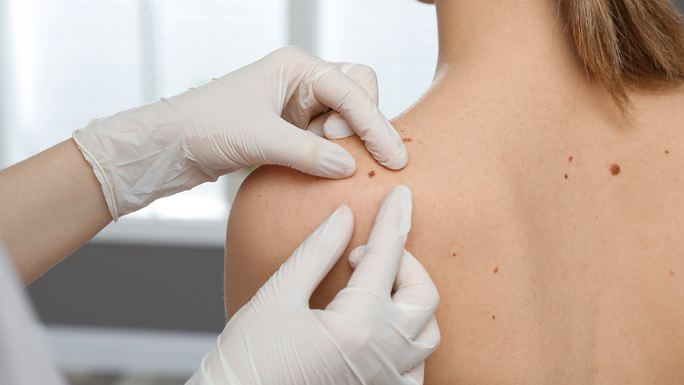 Scarless mole removal: How to minimise scarring after mole removal