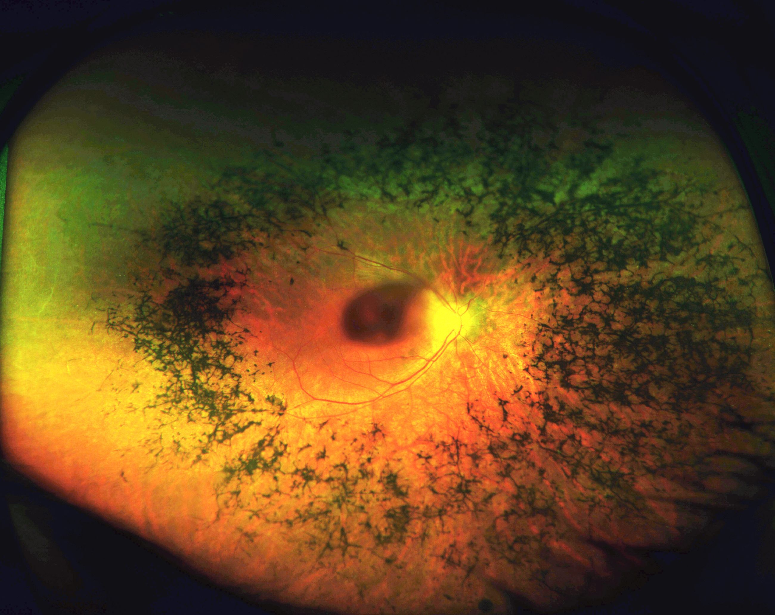 Diseased retina