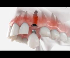 Dental Implants Penrith