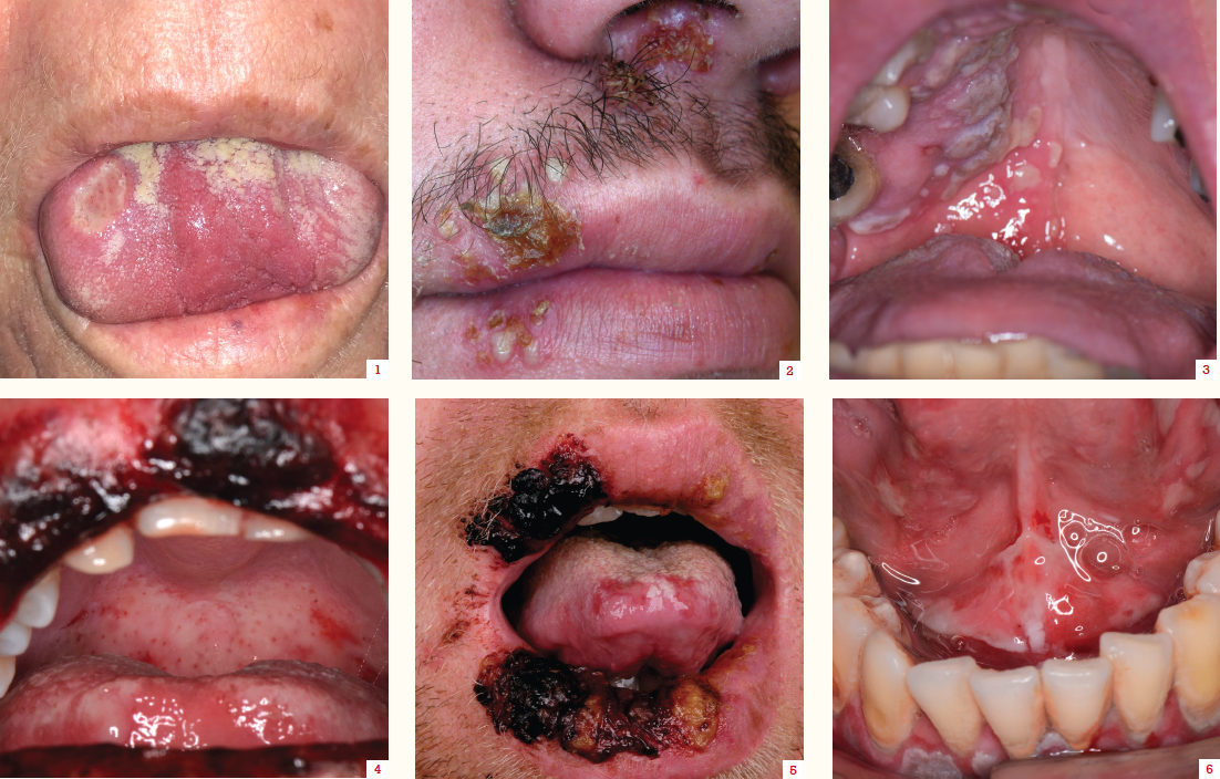 Mouth ulcers can be acute or chronic, with an array of underlying causes