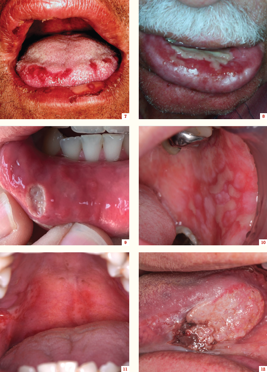 Mouth ulcers can be acute or chronic, with an array of underlying causes