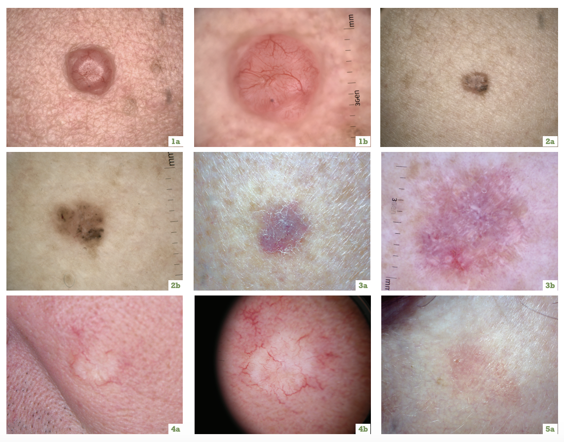 non melanotic skin cancer Nonmelanoma Skin Cancer: Symptoms, Types & Treatment