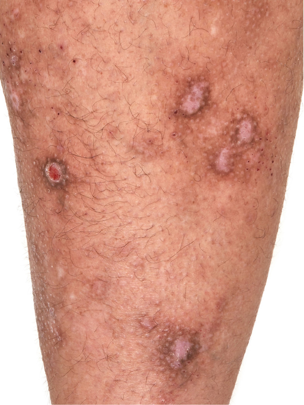 Managing severe atopic dermatitis with culturally informed approach