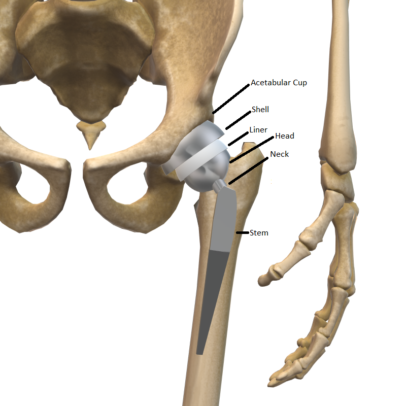 When recovery from total hip replacement doesn't go to plan