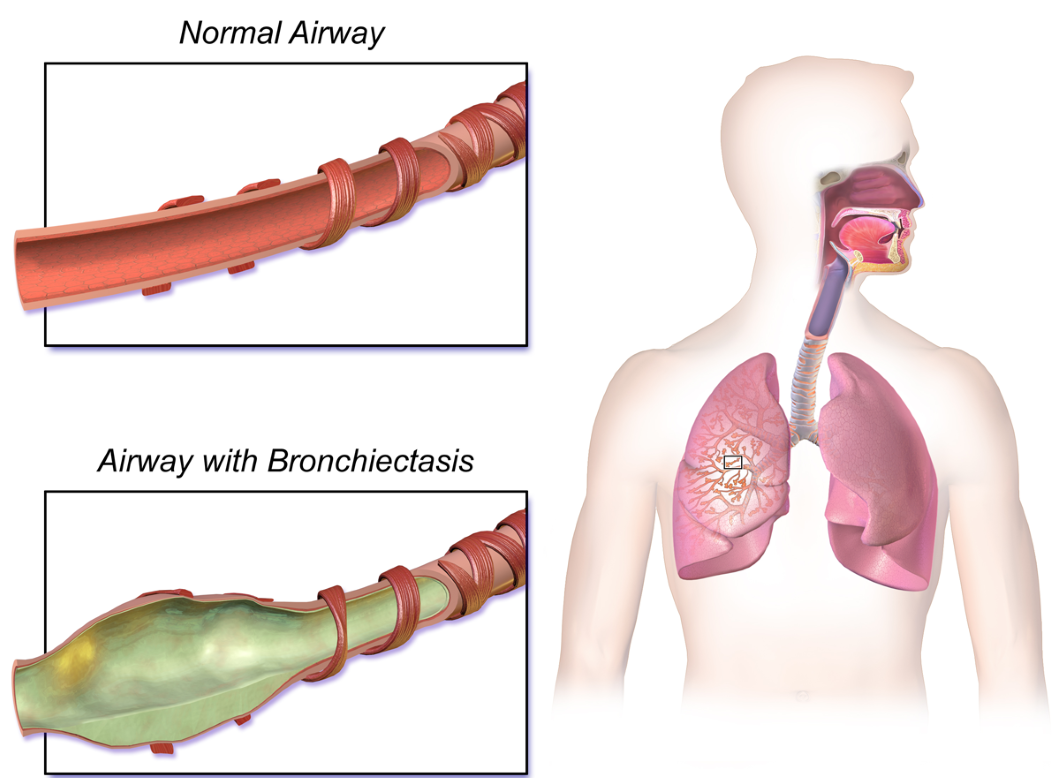 From childhood asthma to bronchiectasis at 65