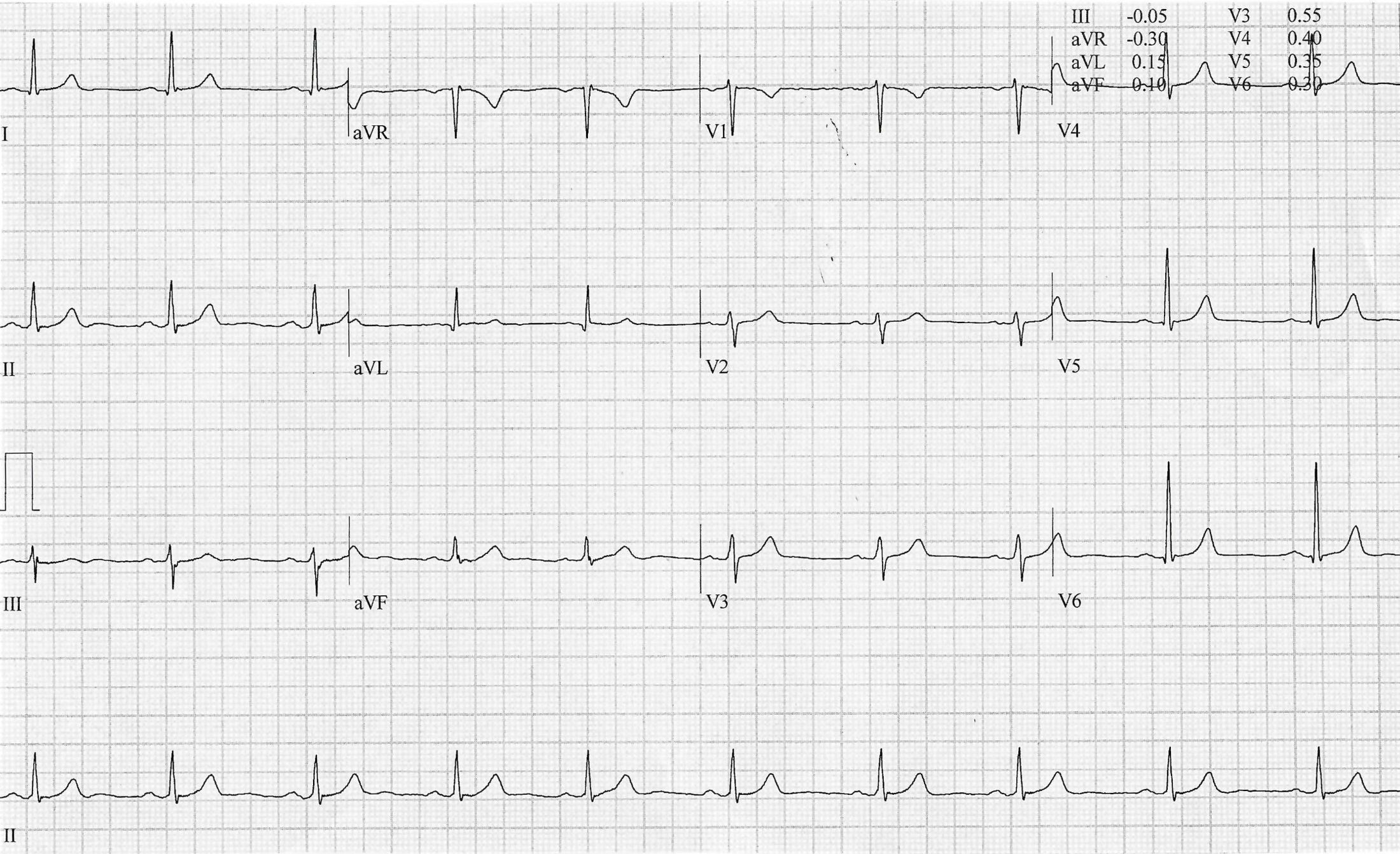 High cholesterol and family history: Please treat with lipid medication