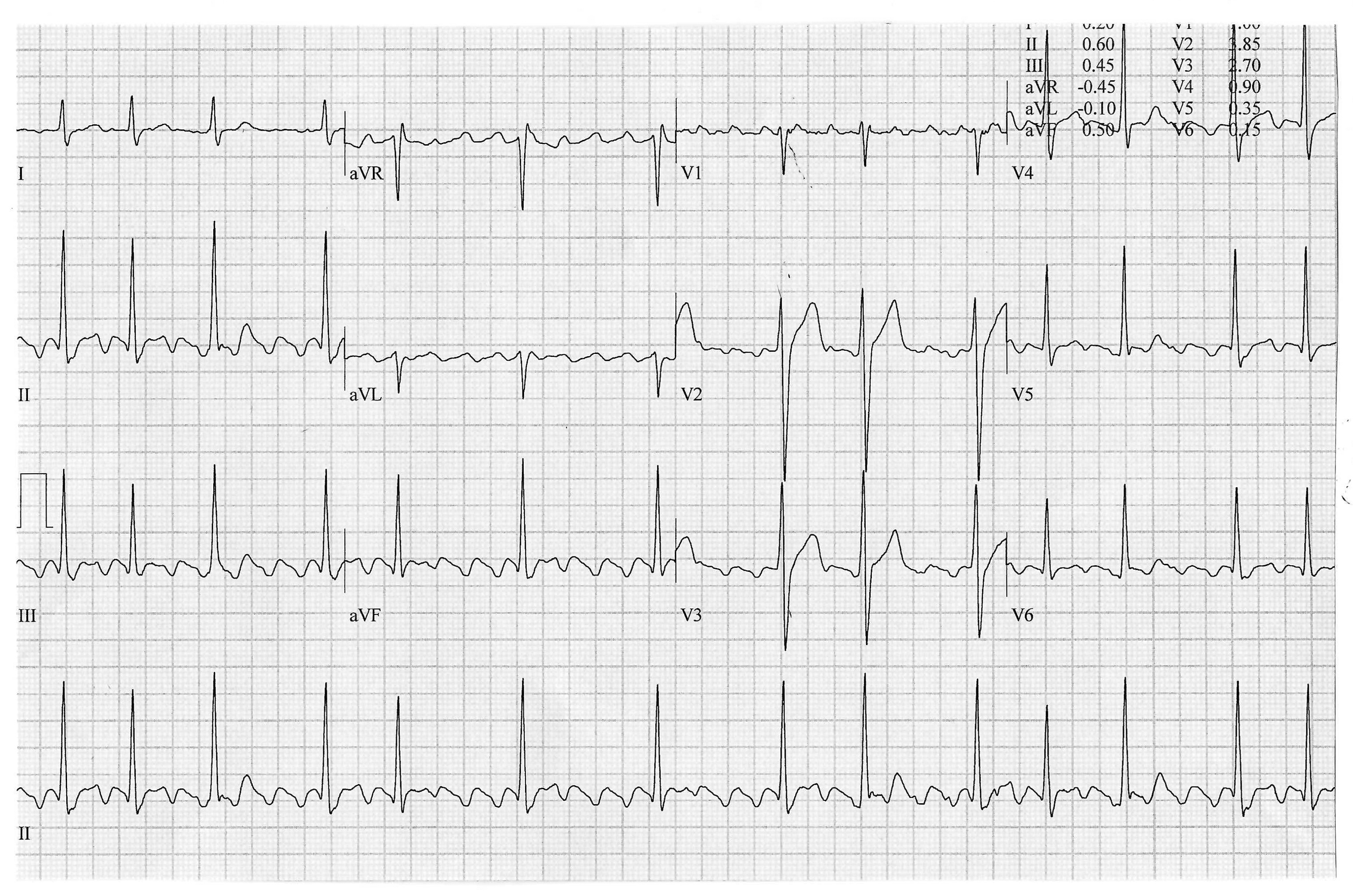 Atrial flutter, anticoagulation and bleeding: What should you do?