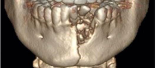 tobacco jaw removal Medical Must-See: Vape blows hole in teen's jaw