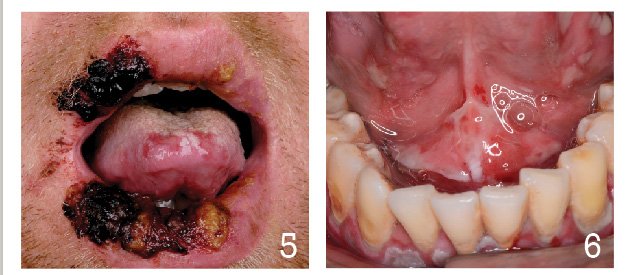 Mouth ulcers can be acute or chronic, with an array of underlying causes