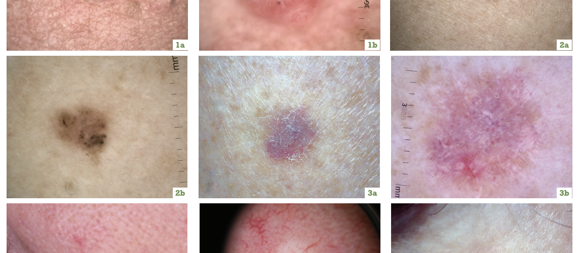 non melanotic invasive skin cancer Increase your confidence in using dermatoscopy to diagnose non-melanoma skin cancers