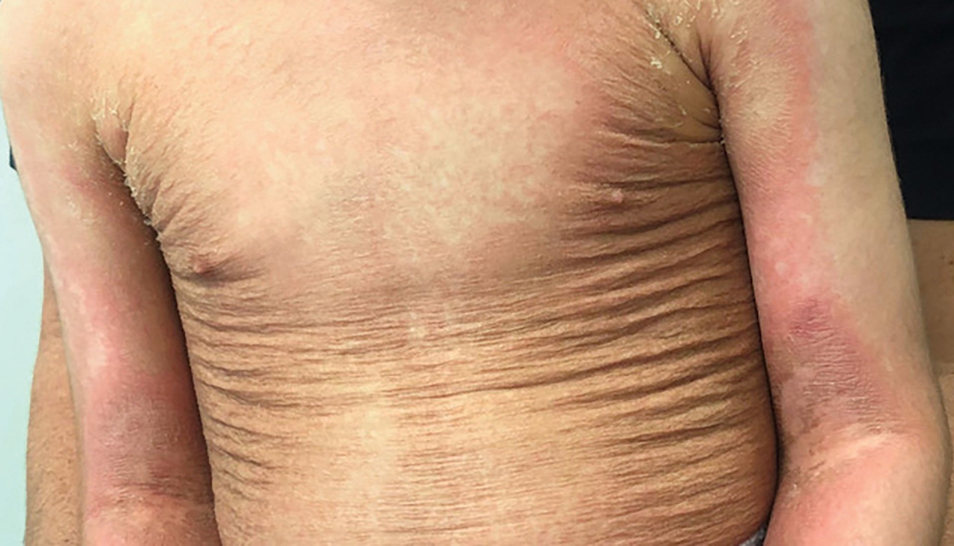 axillary granular parakeratosis images