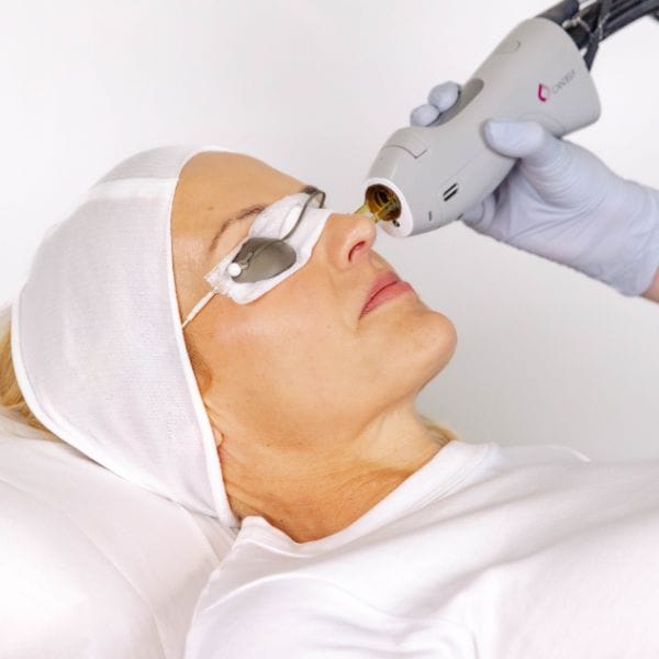 Laser for Pigmentation - Decolletage
