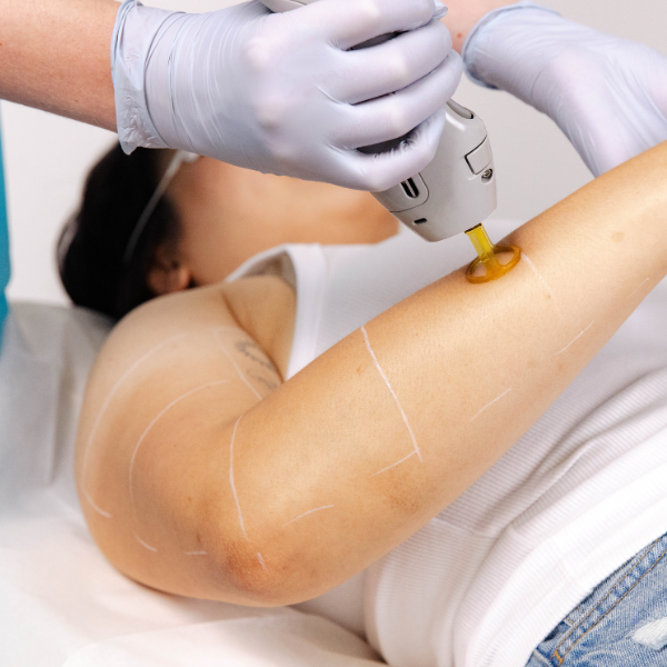 Laser for Pigmentation - Arms - Half