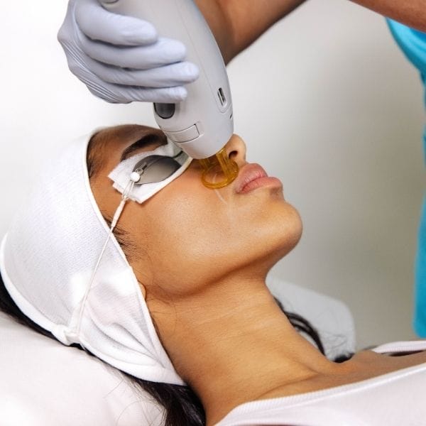 Laser Hair Removal - Upper Lip