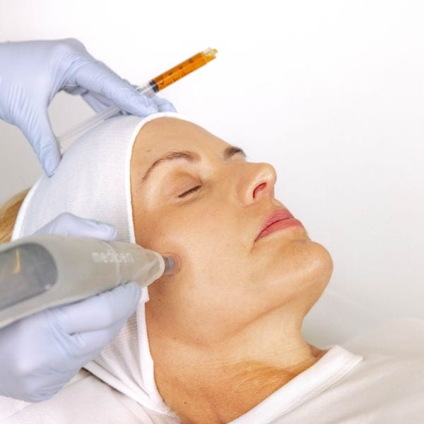 MesoInfus™ Microneedling - Face