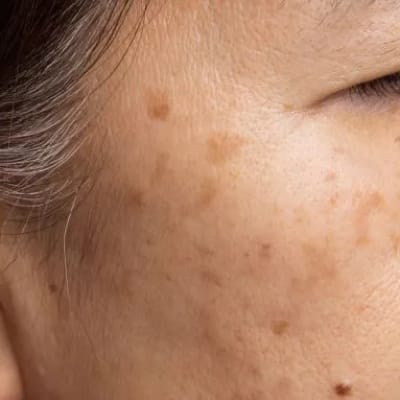 Age spots on the right side of an Asian woman’s face near the eye and cheek.