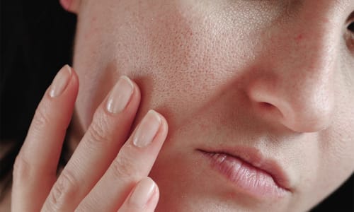 Close-up of a person’s cheek showing enlarged pores.